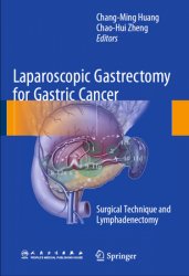 Laparoscopic Gastrectomy for Gastric Cancer: Surgical Technique and Lymphadenectomy