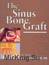 The Sinus Bone Graft